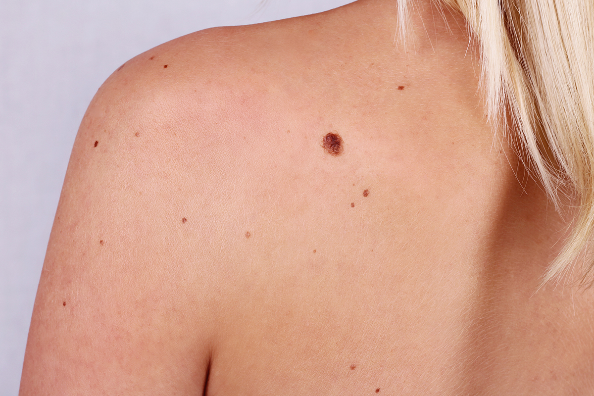 Scopri Mappatura dei Nevi e Diagnosi Precoce del Melanoma